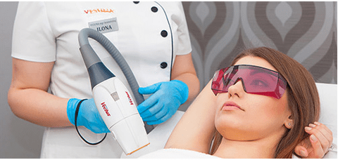 Rajeunissement au laser