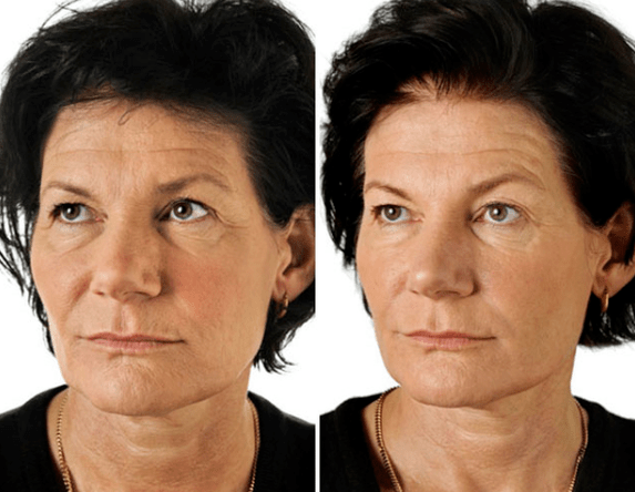 Le résultat du rajeunissement fractionnaire du visage