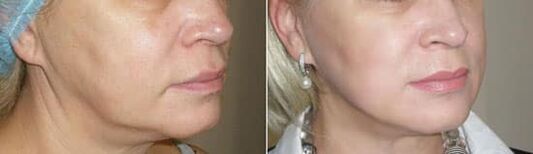 Photo après application de la procédure